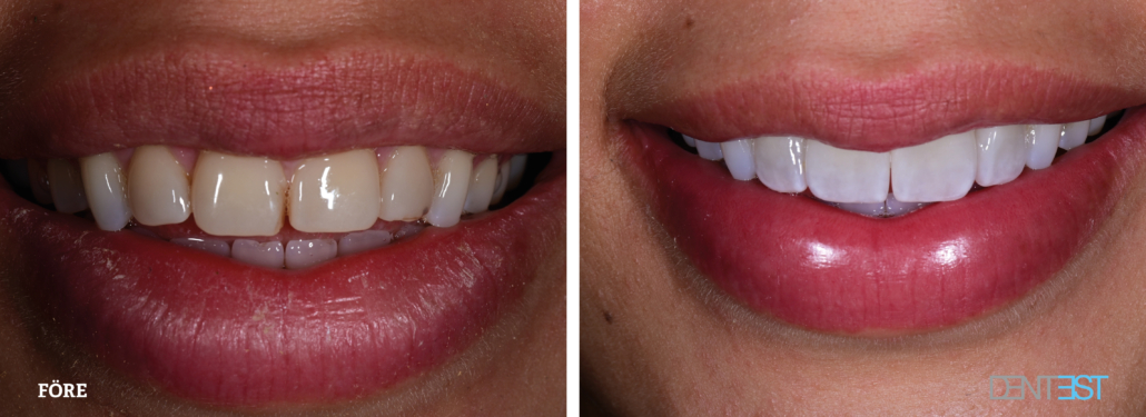 1-Skalfasad Dentest 2025