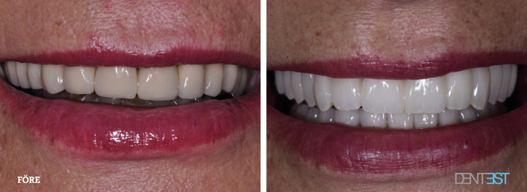 Dentest-före-efter_ implantatbehandling Tandläkare Lund