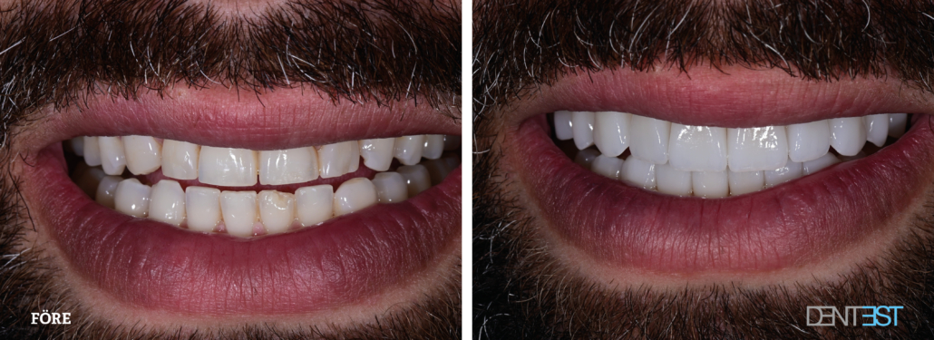 Dentest-före-efter_skalfasad man