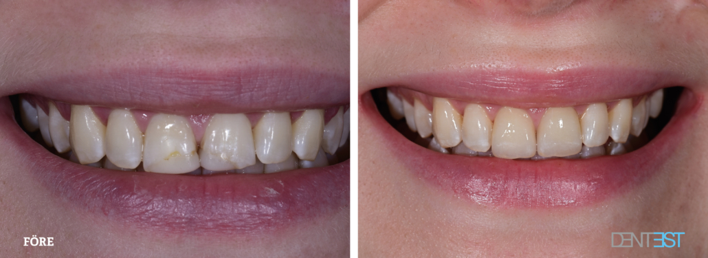Komposit_före-efter_Tandläkare Lund estetils tandvård