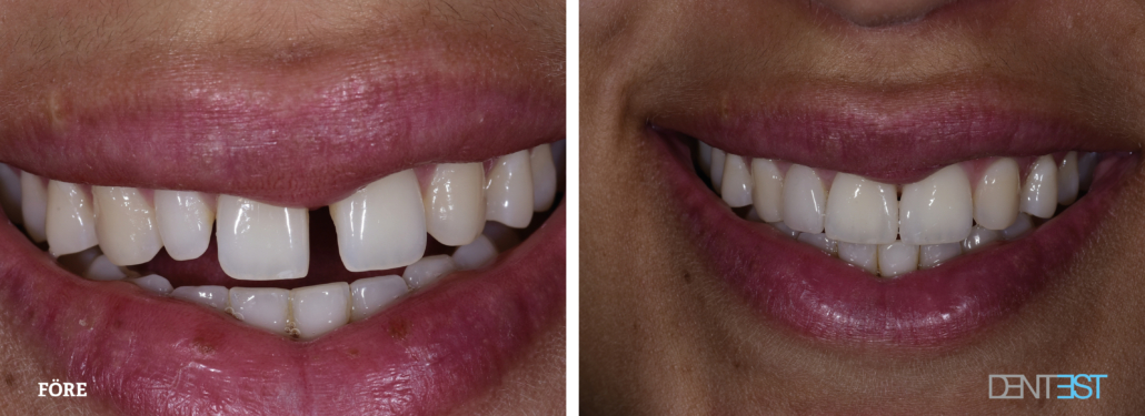 Komposit_före-efter_Tandläkare Lund estetisk tandvård2