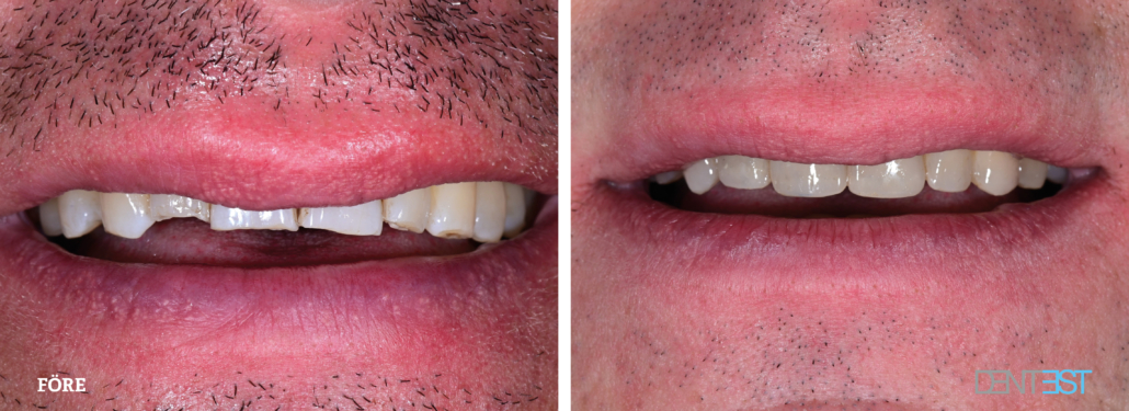 Komposit_före-efter_Tandläkare Lund estetisk tandvård3