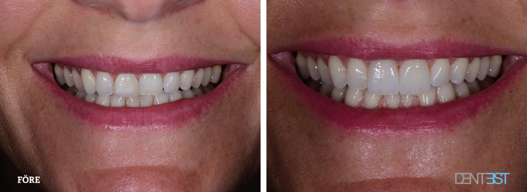 Skalfasad Dentest före efter Linda