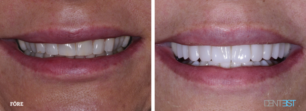 Skalfasad fall 8 2025