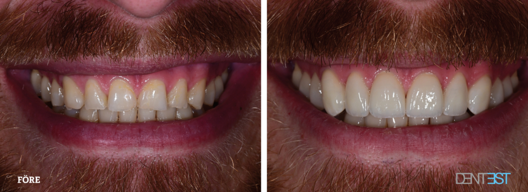 Skalfasd man 2 Dentest