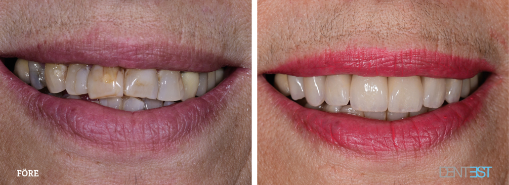 Dentest-före-efter_Tandläkare kronor och broar