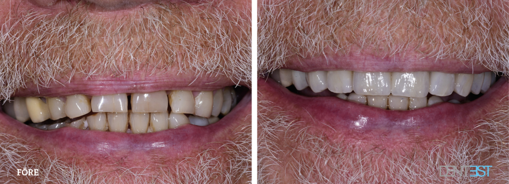 Dentest-före-efter_Tandläkare kronor och broar3