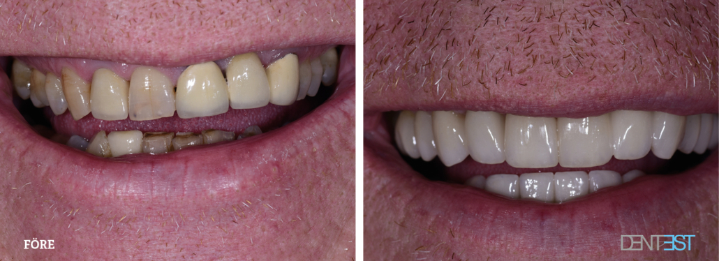 Dentest-före-efter_Tandläkare kronor och broar5