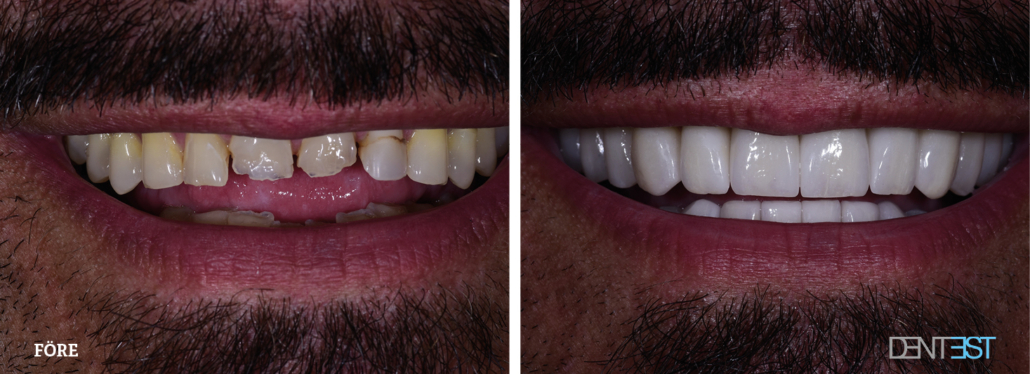 Dentest-före-efter_Tandläkare kronor och broar6