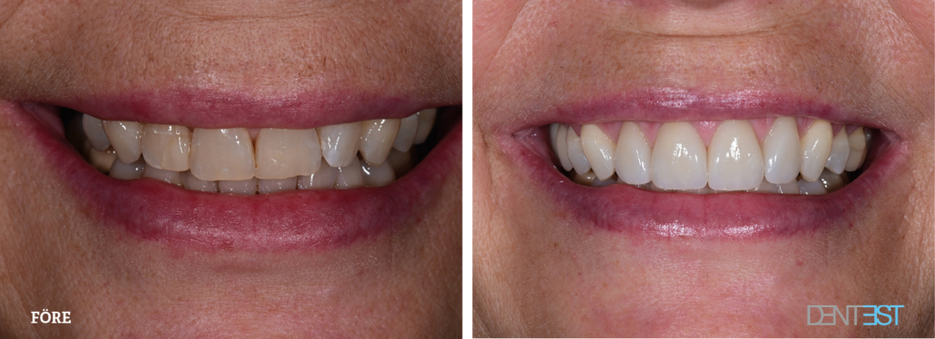 Dentest-före-efter_skalfasader 7Lund estetils tandvård